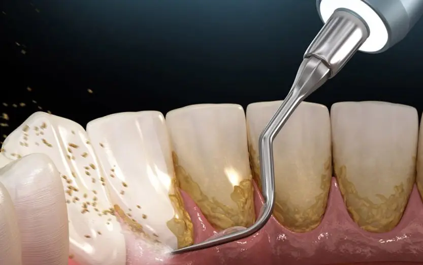 Diş Taşı Temizliği ( Detertraj )