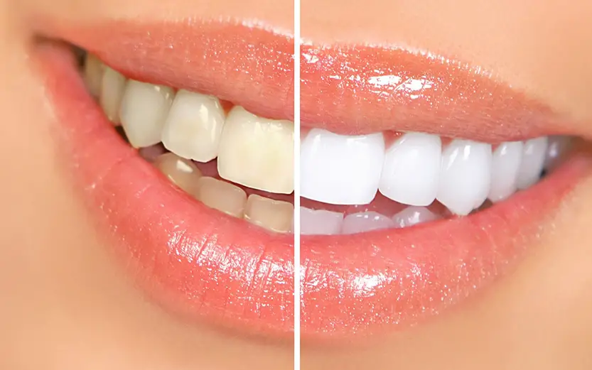 Diş Beyazlatma ( Bleaching )