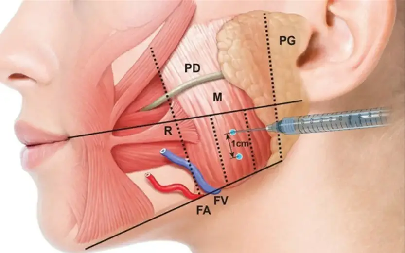 Masseter Botoks