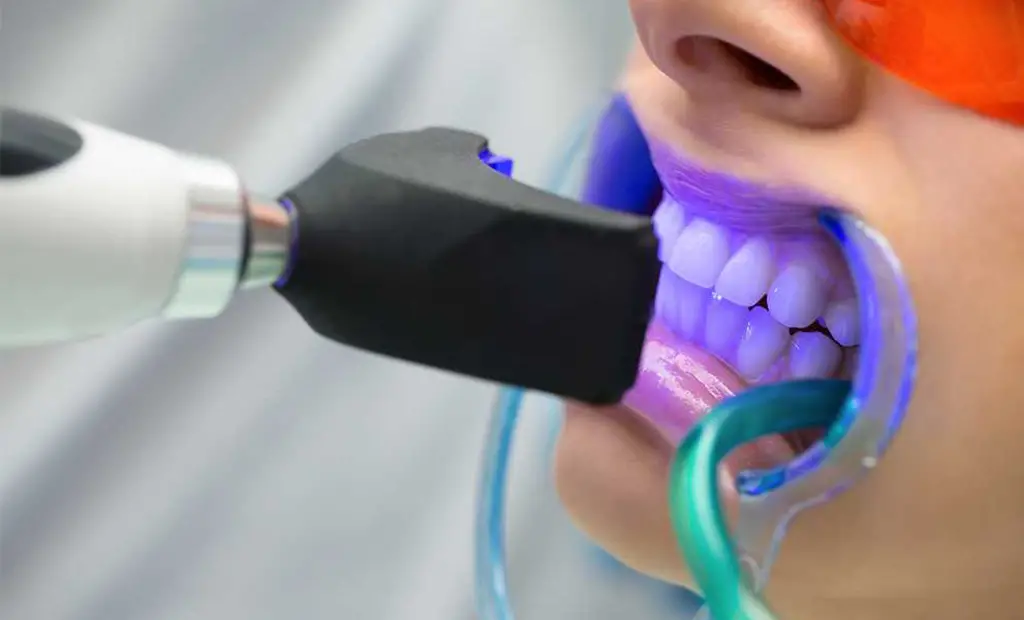 Diş beyazlatmanın kontrendikasyonları nelerdir?